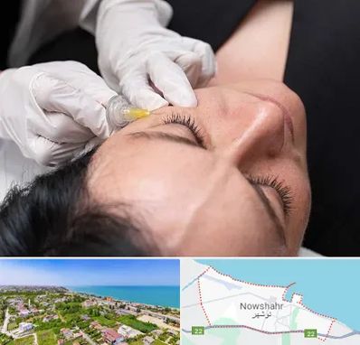 کربوکسی تراپی در نوشهر