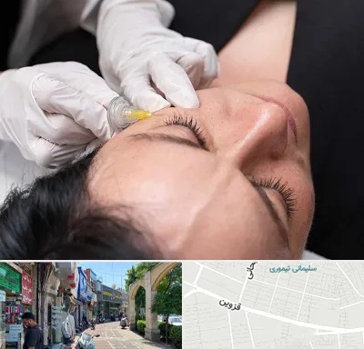 کربوکسی تراپی در خیابان قزوین