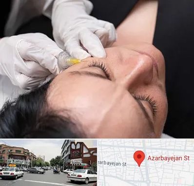 کربوکسی تراپی در خیابان آذربایجان