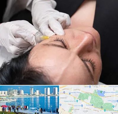 کربوکسی تراپی در چیتگر 