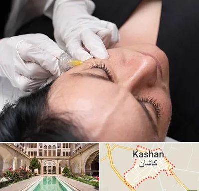 کربوکسی تراپی در کاشان