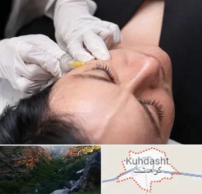 کربوکسی تراپی در کوهدشت