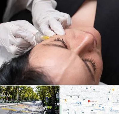 کربوکسی تراپی در میرداماد 