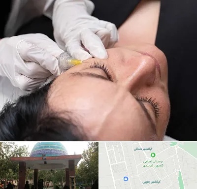 کربوکسی تراپی در کیانشهر