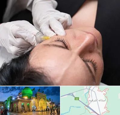 کربوکسی تراپی در آستانه اشرفیه