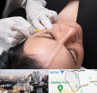 کربوکسی تراپی در الهیه 