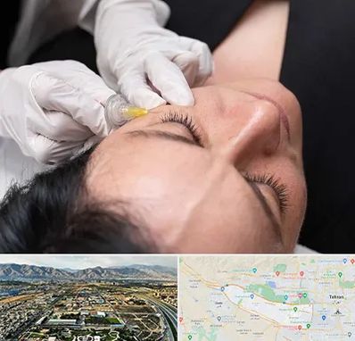 کربوکسی تراپی در منطقه 21 تهران 