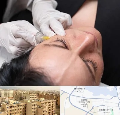 کربوکسی تراپی در جنوب غرب تهران