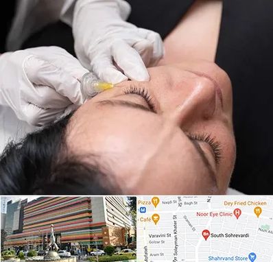 کربوکسی تراپی در سهروردی 