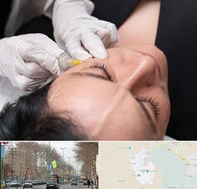 کربوکسی تراپی در نظرآباد کرج 