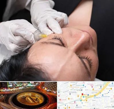 کربوکسی تراپی در میدان ولیعصر 