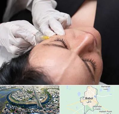 کربوکسی تراپی در بابل