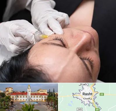 کربوکسی تراپی در رشت