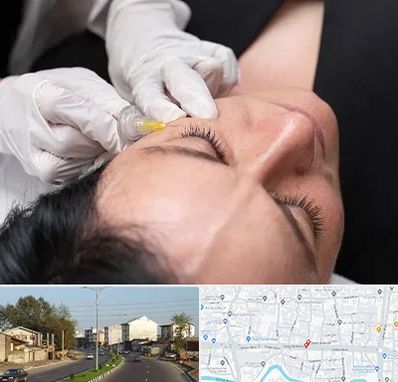 کربوکسی تراپی در ضیابری رشت