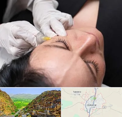 کربوکسی تراپی در کامیاران