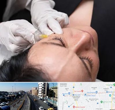 کربوکسی تراپی در پیروزی 