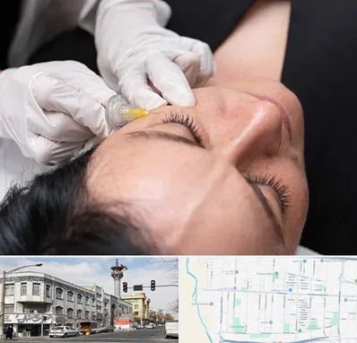 کربوکسی تراپی در 17شهریور