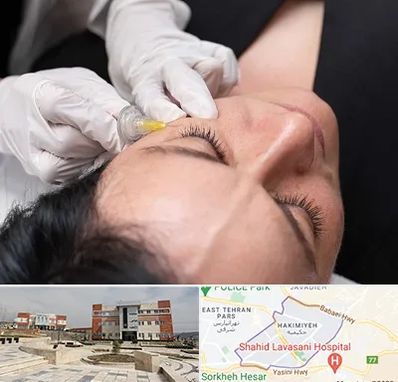 کربوکسی تراپی در حکیمیه 