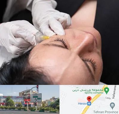 کربوکسی تراپی در هروی 