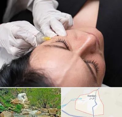 کربوکسی تراپی در کردان