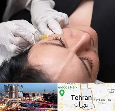 کربوکسی تراپی در صادقیه 