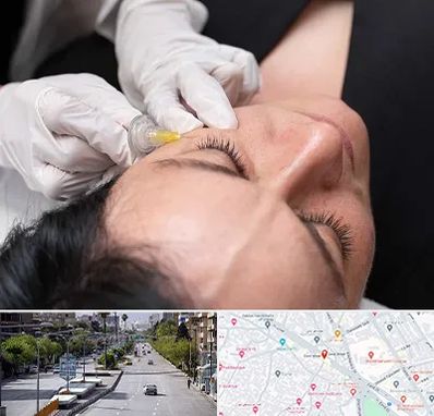 کربوکسی تراپی در خیابان زند شیراز