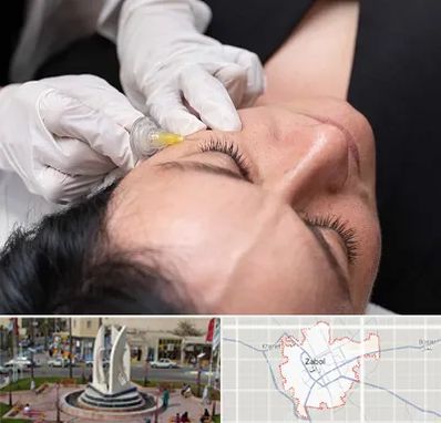 کربوکسی تراپی در زابل
