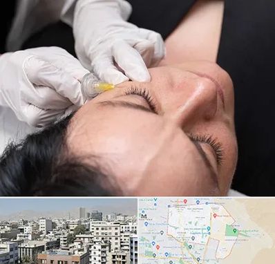 کربوکسی تراپی در منطقه 14 تهران 