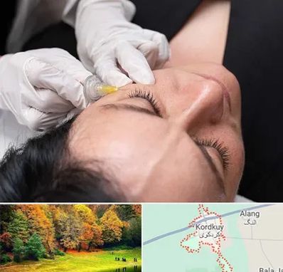 کربوکسی تراپی در کردکوی