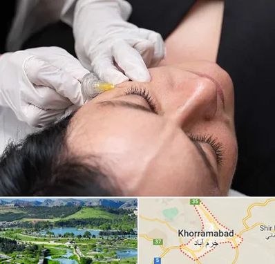 کربوکسی تراپی در خرم آباد