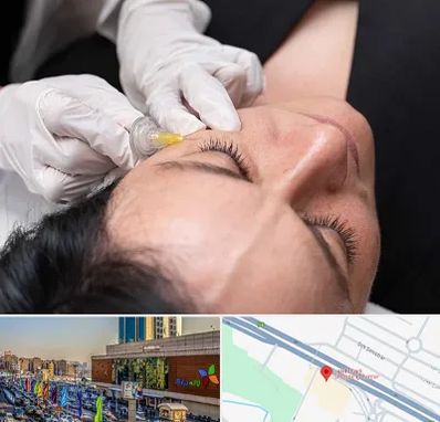 کربوکسی تراپی در لاله پارک تبریز