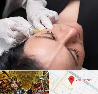 کربوکسی تراپی در بازار وکیل شیراز