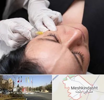 کربوکسی تراپی در مشکین دشت