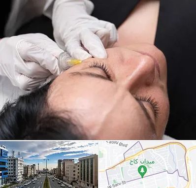 کربوکسی تراپی در سعادت آباد 