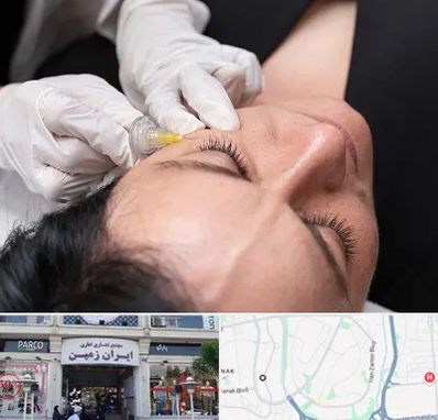 کربوکسی تراپی در ایران زمین