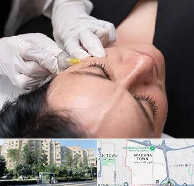 کربوکسی تراپی در آپادانا