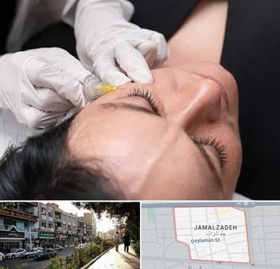 کربوکسی تراپی در خیابان جمالزاده