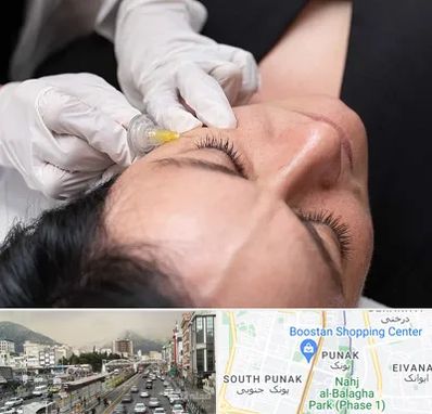 کربوکسی تراپی در پونک 