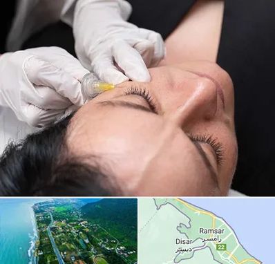 کربوکسی تراپی در رامسر