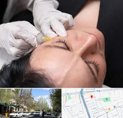 کربوکسی تراپی در کوی فیروز تبریز