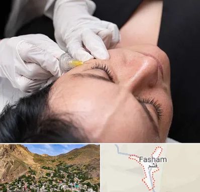 کربوکسی تراپی در فشم