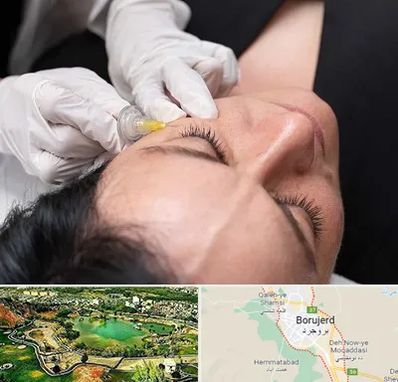 کربوکسی تراپی در بروجرد