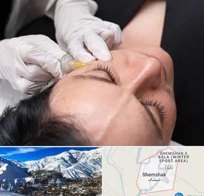 کربوکسی تراپی در شمشک