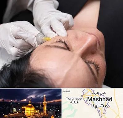 کربوکسی تراپی در مشهد