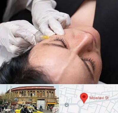 کربوکسی تراپی در مولوی
