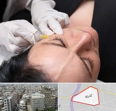 کربوکسی تراپی در آذری