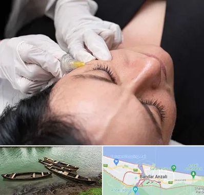 کربوکسی تراپی در بندر انزلی