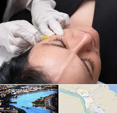 کربوکسی تراپی در خرمشهر