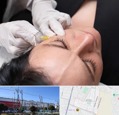 کربوکسی تراپی در فاز دو اندیشه