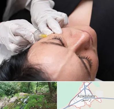 کربوکسی تراپی در آزادشهر
